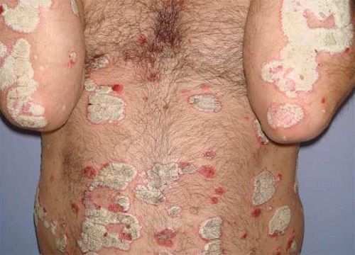 Atopichesky la dermatitis la causa de la enfermedad
